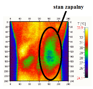 Rys. 25. Stan zapalny prawego kolana. Rys. 26. Diagnostyka nowotworów piersi. Budowa lasera i właściwości promieniowania laserowego.
