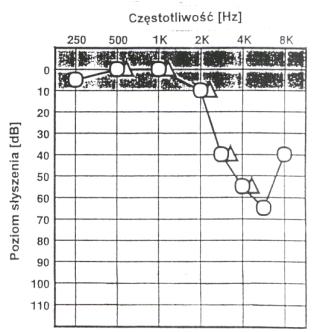 Results on an Audiogram White area is inaudible Tan area is audible Anatomy of Hearing Loss