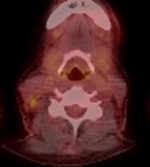 Results In 3 patients local or regional recurrence was found in PET scanning only due to detectable HPV DNA After 4 months