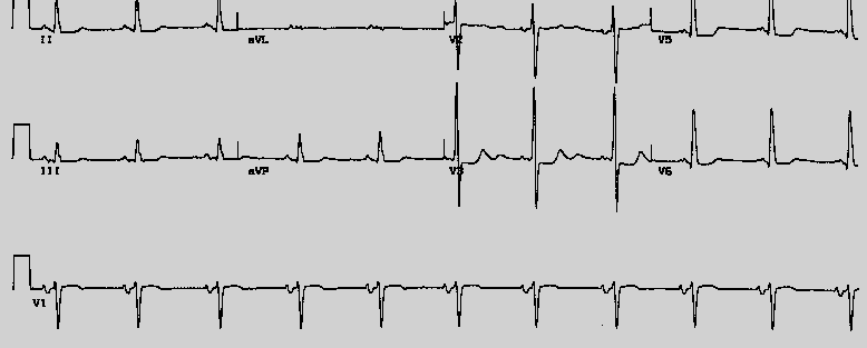 EKG -