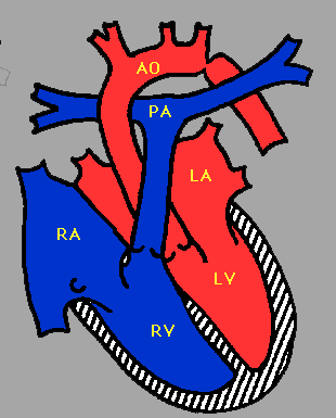 Wady z przewodozależnym przepływem systemowym Krytyczne zwężenie cieśni aorty (koarktacja) Przerwanie ciągłości łuku aorty cieśń