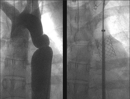 Wady z przewodozależnym przepływem systemowym Walwuloplastyka balonowa zastawki aorty-