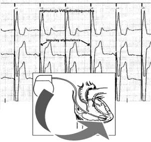 Miejsce stymulowane pierwsza litera kodu V ventricle stymulacja komory A atrium stymulacja przedsionka D dual stymulacja przedsionka i komory BiA biatrial stymulacja dwuprzedsionkowa BiV