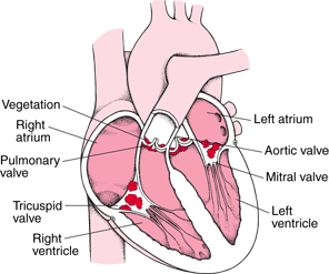 Definicja INFEKCYJNE ZAPALENIE WSIERDZIA II KATEDRA KARDIOLOGII CM UMK 2014 Wewnątrznaczyniowe zakażenie obejmujące struktury serca (np.