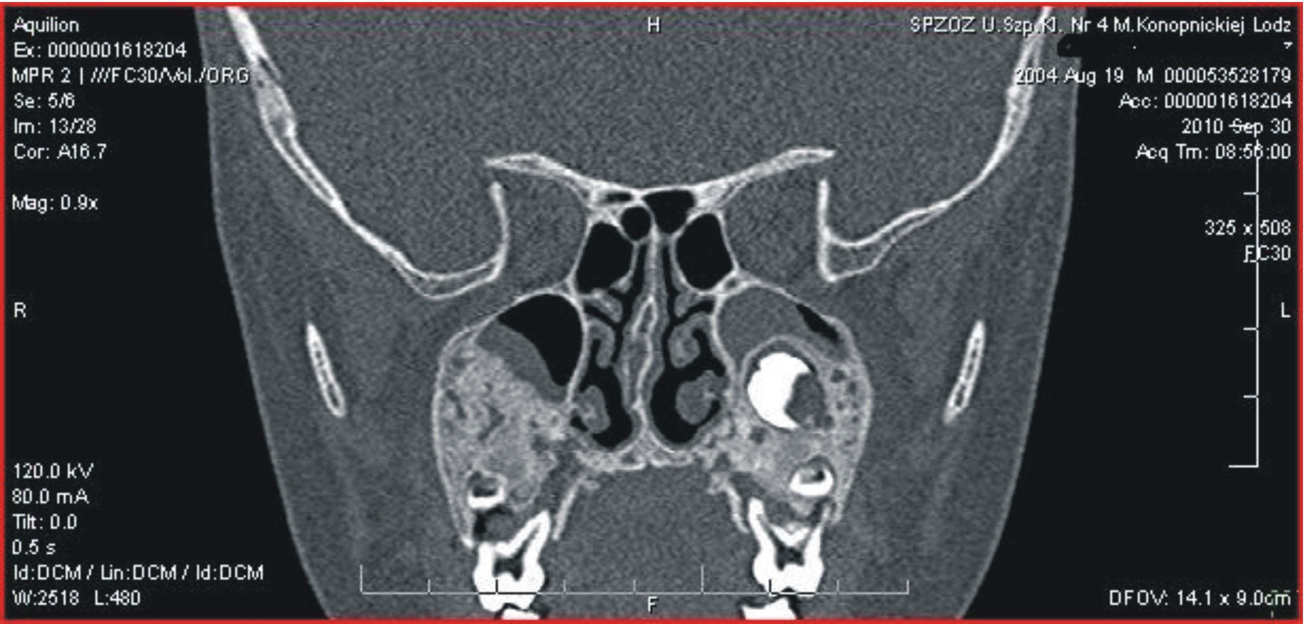 Patient I.J. Computed tomography scan showing periapical inflammation around 26 tooth. Rycina 3 Pacjent M.P. Tomografia zatok.