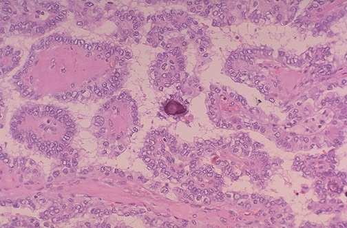 (FTC) - 5-15% (5-30%) RAK ANAPLASTYCZNY (ATC) - < 5% RAK RDZENIASTY (MTC) - 5% POORLY DIFFERENTIATED CARCINOMA (PDC)- INSULAR CA RAK BRODAWKOWATY (PTC) najczęstszy typ histologiczny- wg róŝnych