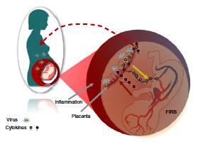 Matka-łożysko-płod: kompleksowa odpowiedź na stan zapalny w łożysku FIRS fetal inflammatory response syndrome, stan zapalny płodu charakteryzujący się dużym stężeniem IL-1, IL-6, IL-8, TNF-a.