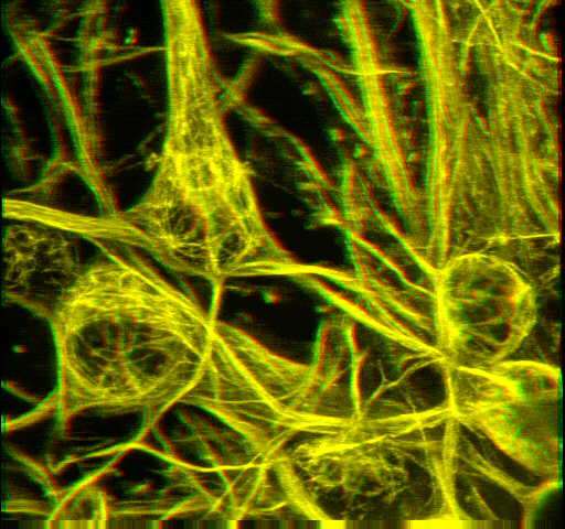 Neurofibryle To co 100 lat temu opisywano jako neurofibryle jest wewnątrzkomórkowymi, złożonymi polimerami białkowymi utworzonymi z neurotubul,
