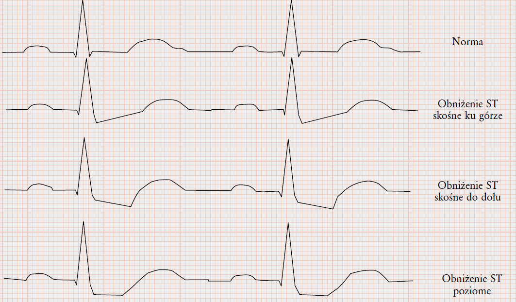 Obniżenia ST (mierzone w punkcie J): Odpr.