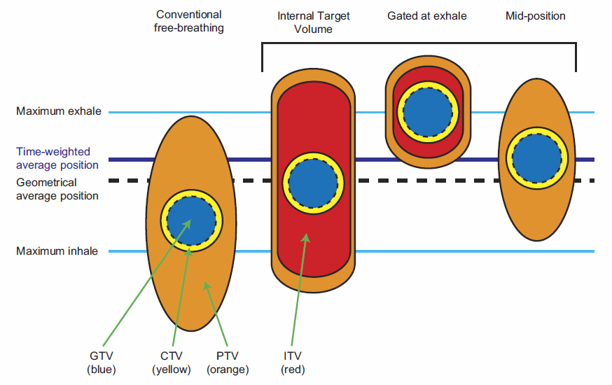 Schematyczny przegląd różnych koncepcji leczenia: na swobodnym oddechu, ITV (internal target