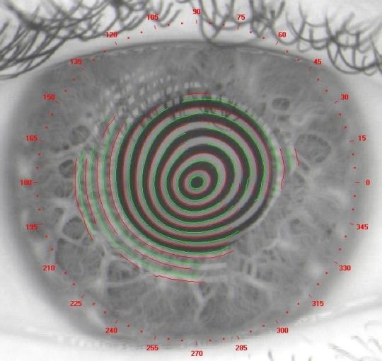 index: K > 47,2 D I-S > 1,4 D