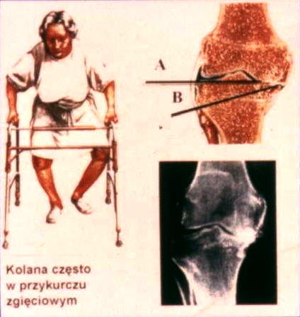 A. zwężenie przedziału przyśrodkowego jamy stawowej z podwichnięciem B.