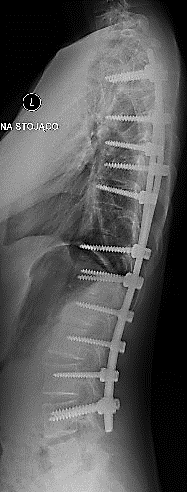 (leczenie skoliozy z dostępu