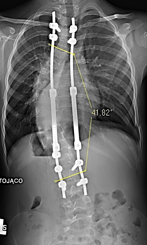 Katalog Procedur Kręgosłupowych z Użyciem Implantu - PDF Free Download