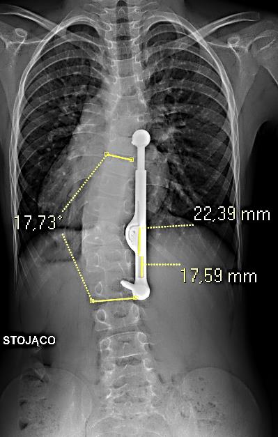 spondylodezy tylna (leczenie