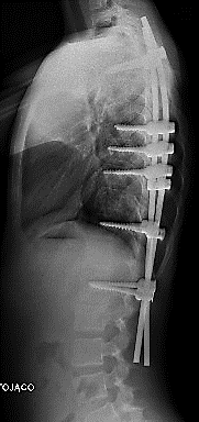 spondylodezy tylna (leczenie