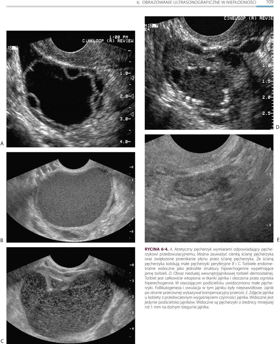 Torbiele endometrialne widoczne jako jednolite struktury hipoechogenne wypełniające jamę torbieli. D. Obraz niedużej wewnątrzjajnikowej torbieli dermoidalnej.