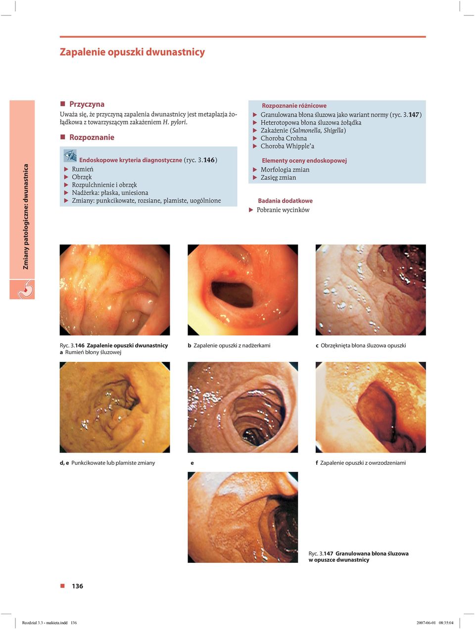 .147) Heterotopowa błona śluzowa żołądka Zakażenie (Salmonella, Shigella) Choroba Crohna Choroba Whipple a Zmiany patologiczne: dwunastnica Endoskopowe kryteria diagnostyczne (ryc.