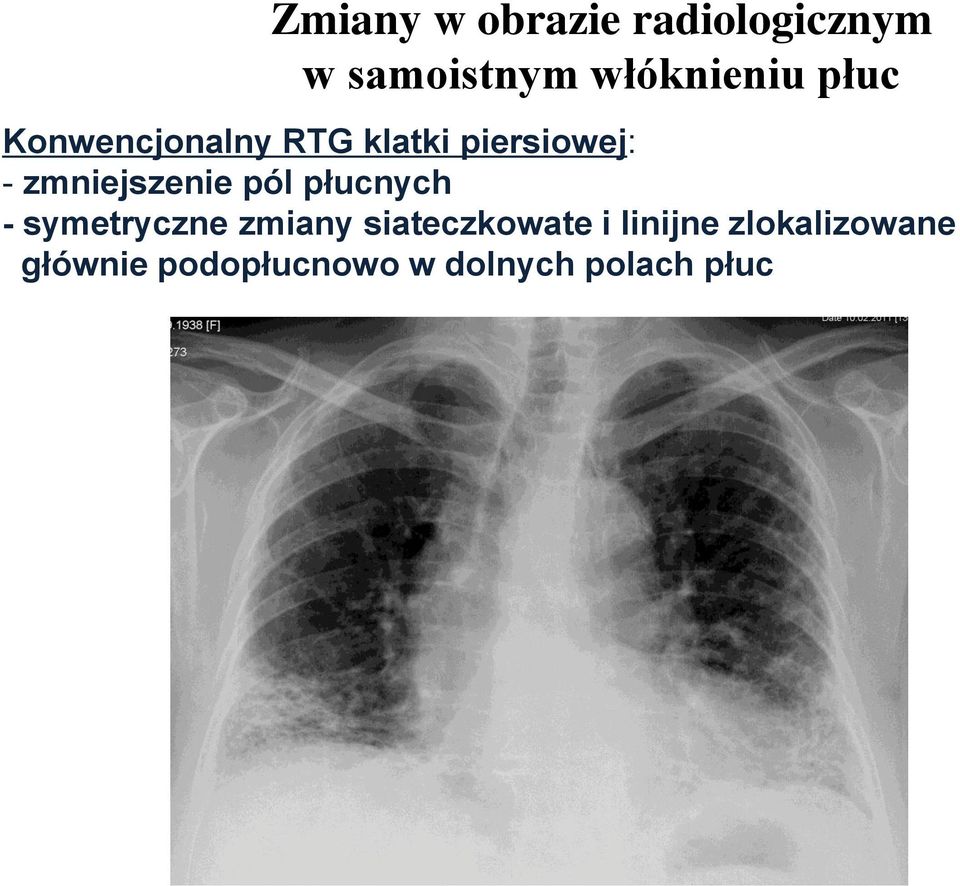 zmniejszenie pól płucnych - symetryczne zmiany