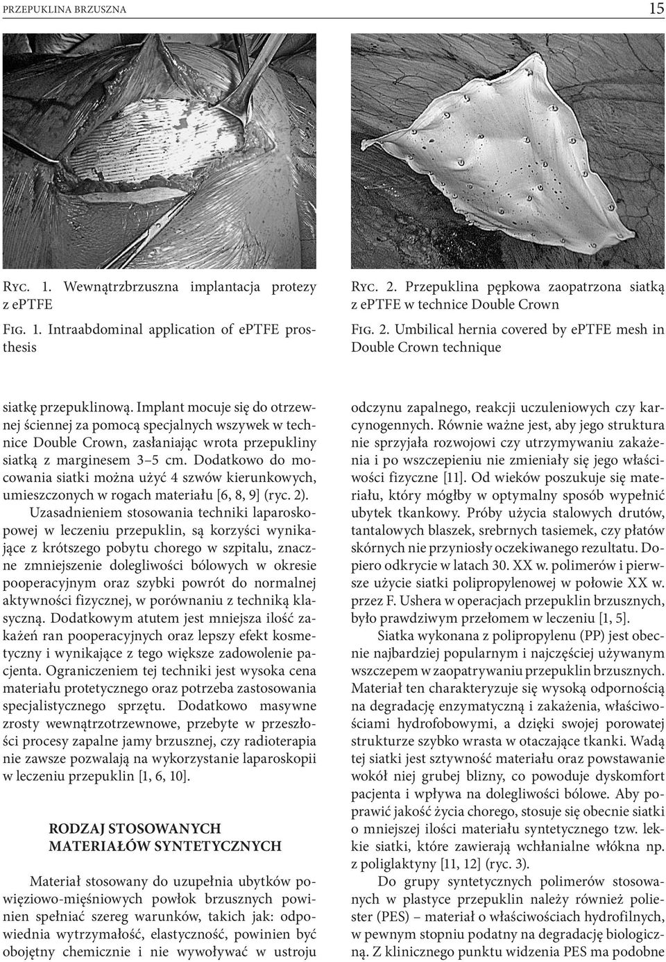 Implant mocuje się do otrzewnej ściennej za pomocą specjalnych wszywek w technice Double Crown, zasłaniając wrota przepukliny siatką z marginesem 3 5 cm.