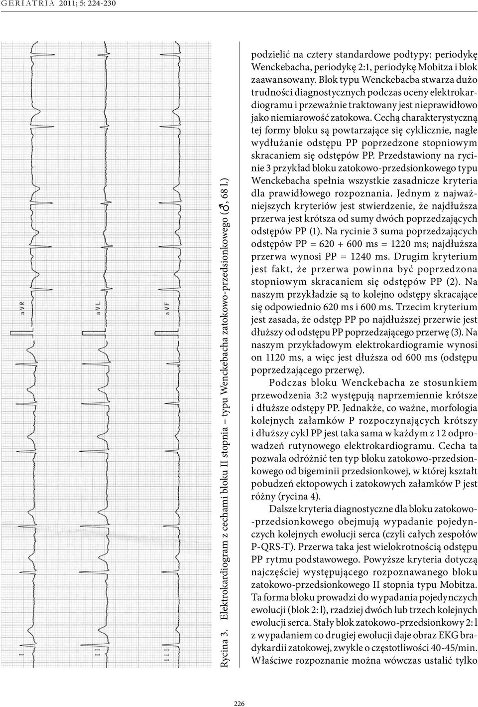 Blok typu Wenckebacba stwarza dużo trudności diagnostycznych podczas oceny elektrokardiogramu i przeważnie traktowany jest nieprawidłowo jako niemiarowość zatokowa.