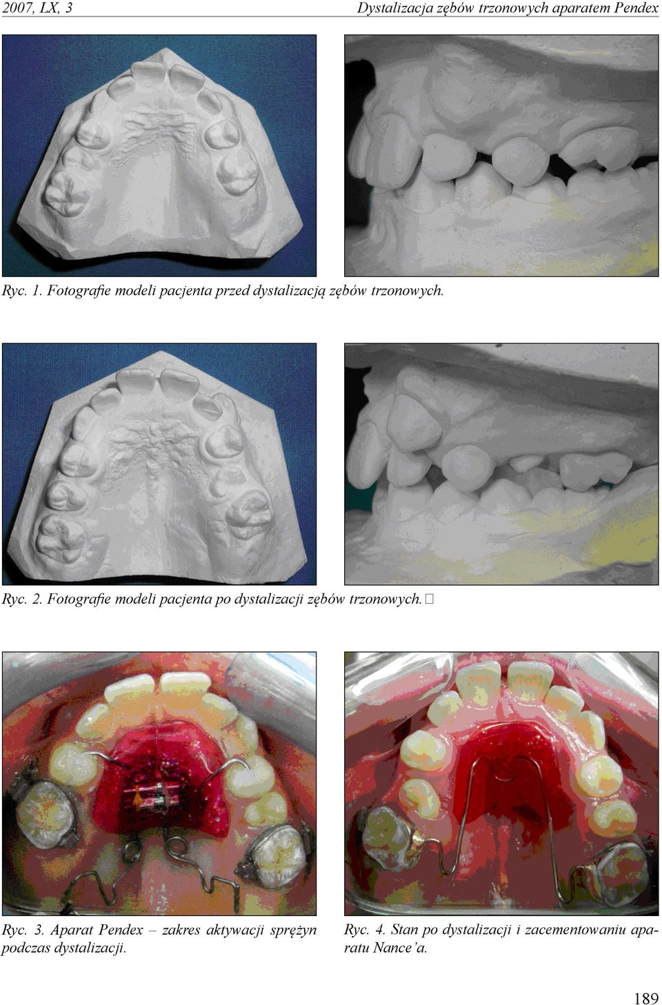 Fotografie modeli pacjenta po dystalizacji zębów trzonowych. Ryc. 3.