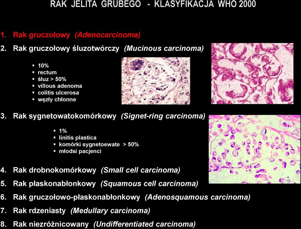Rak sygnetowatokomórkowy (Signet-ring carcinoma) 1% linitis plastica komórki sygnetoewate > 50% młodsi pacjenci 4.