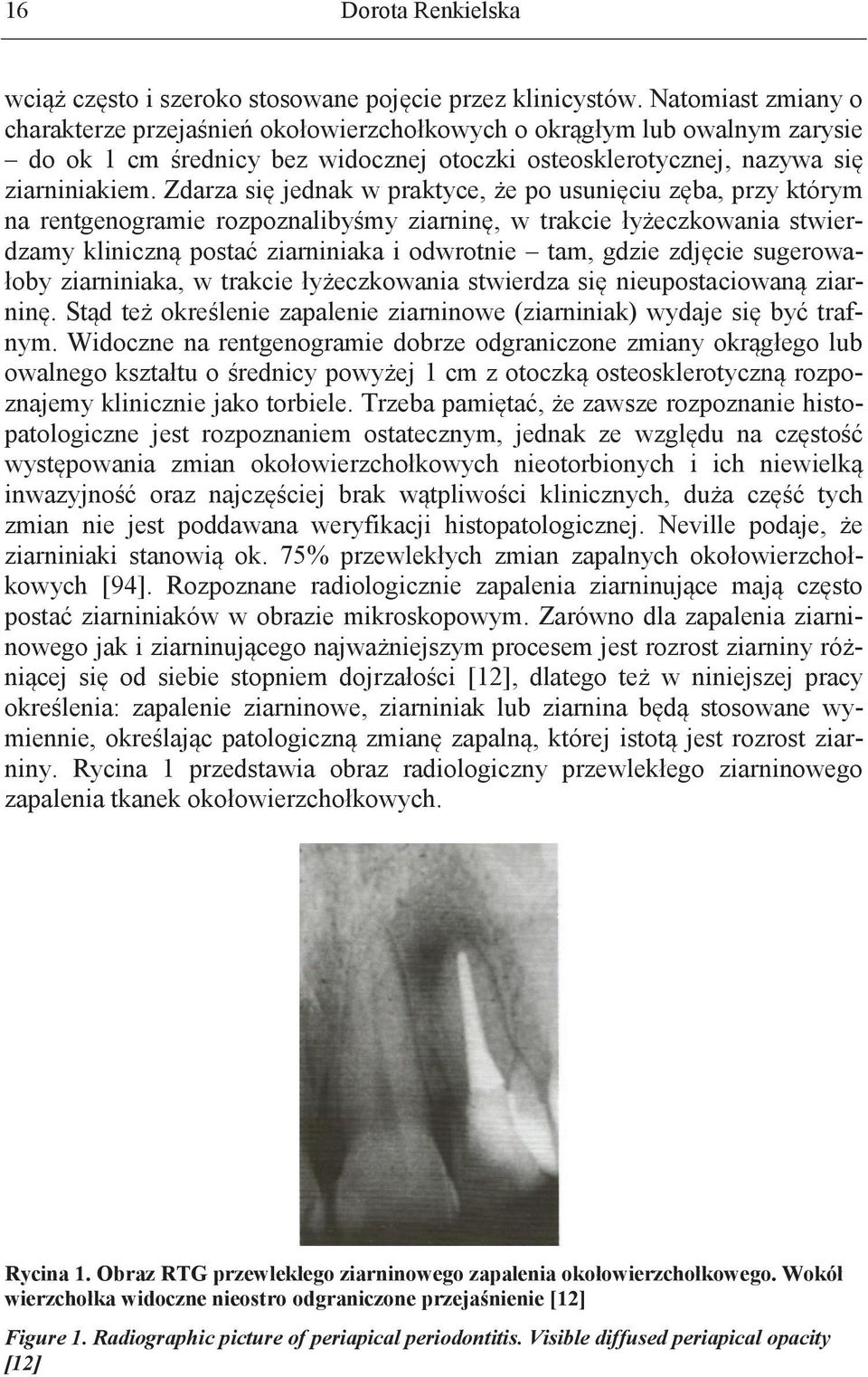Zdarza się jednak w praktyce, że po usunięciu zęba, przy którym na rentgenogramie rozpoznalibyśmy ziarninę, w trakcie łyżeczkowania stwierdzamy kliniczną postać ziarniniaka i odwrotnie tam, gdzie
