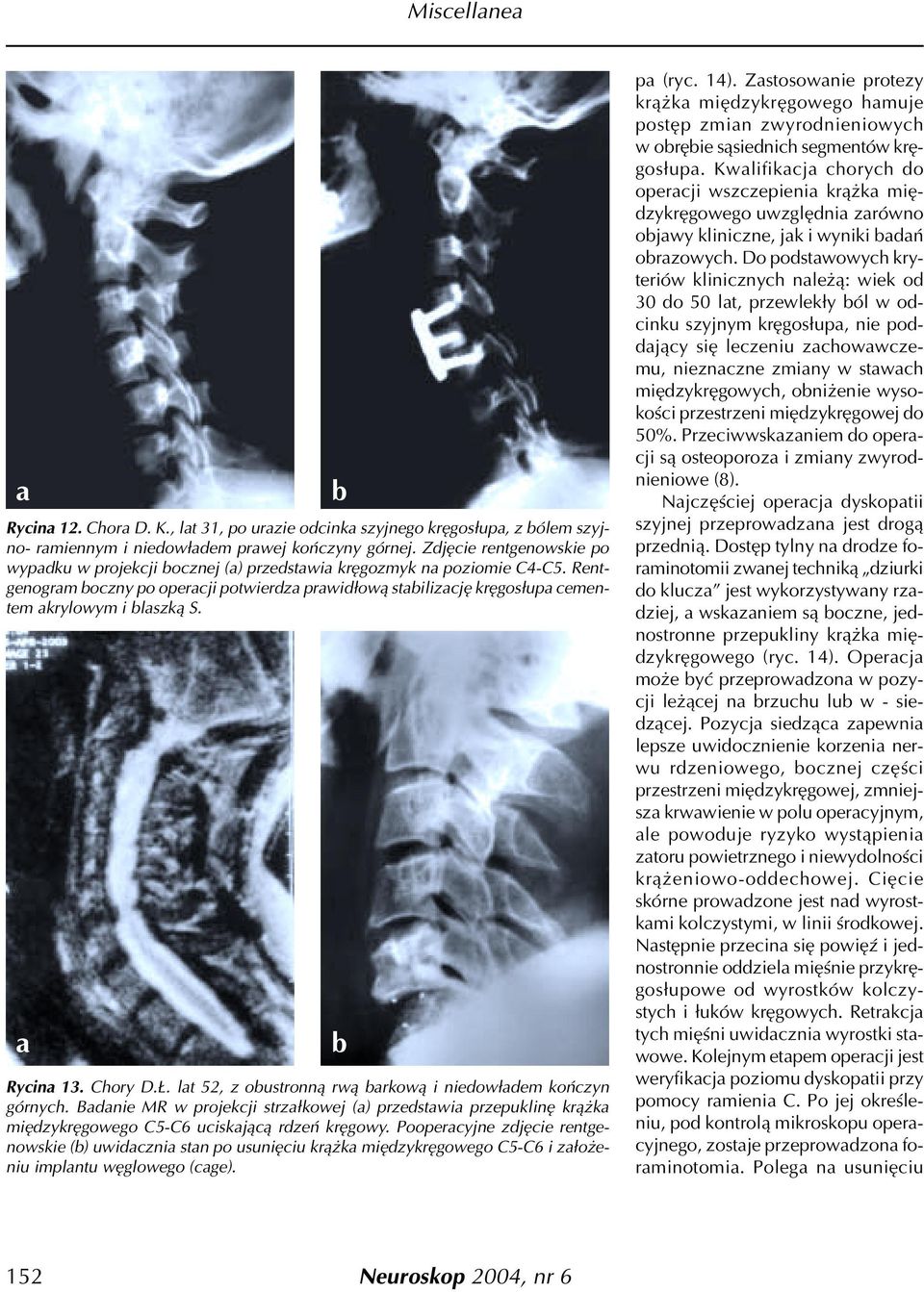Rentgenogram oczny po operacji potwierdza prawid³ow¹ stailizacjê krêgos³upa cementem akrylowym i laszk¹ S. a Rycina 13. Chory D.. lat 52, z oustronn¹ rw¹ arkow¹ i niedow³adem koñczyn górnych.