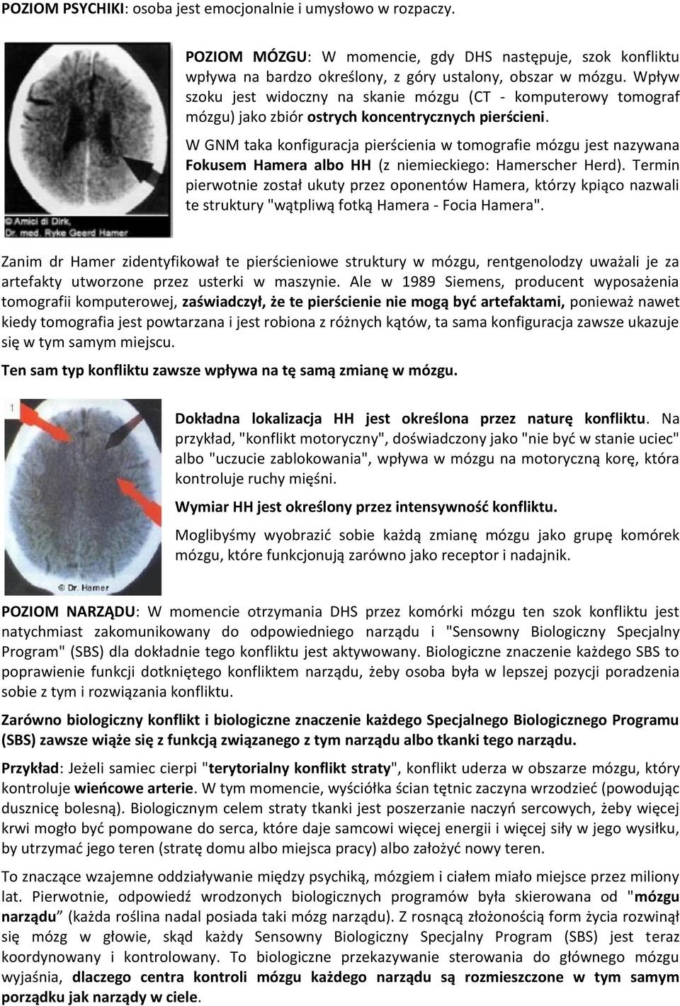 W GNM taka konfiguracja pierścienia w tomografie mózgu jest nazywana Fokusem Hamera albo HH (z niemieckiego: Hamerscher Herd).