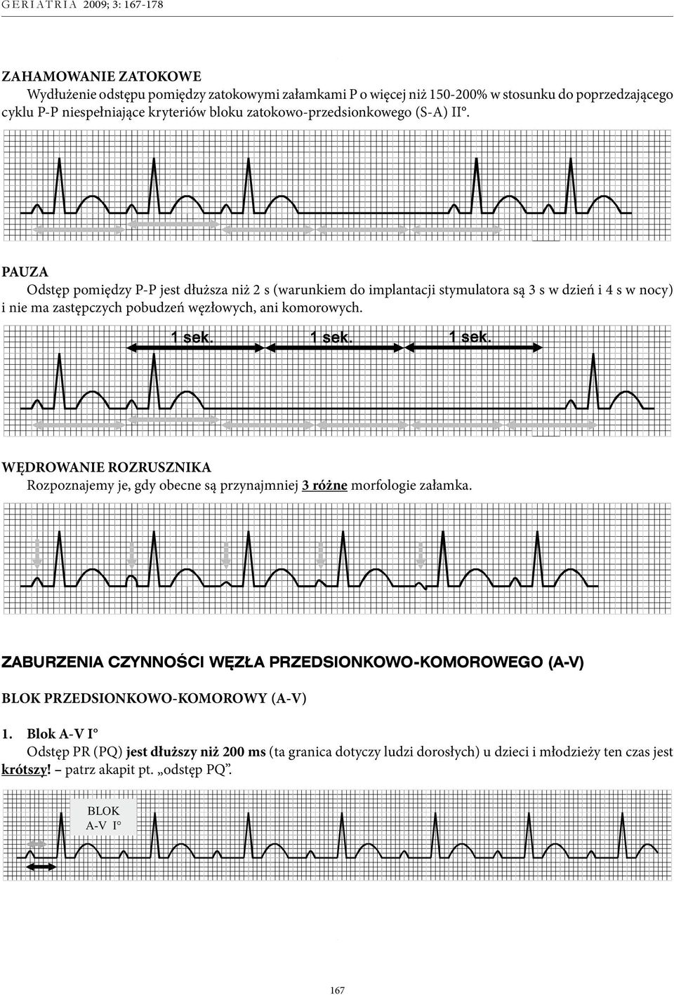 PAUZA Odstęp pomiędzy P-P jest dłuższa niż 2 s (warunkiem do implantacji stymulatora są 3 s w dzień i 4 s w nocy) i nie ma zastępczych pobudzeń węzłowych, ani komorowych. 1 sek.