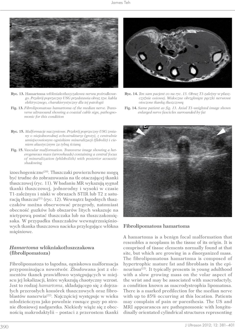 Widoczne obrzęknięte pęczki nerwowe otoczone tkanką tłuszczową Fig. 14. Same patient as fig. 13. Axial T1-weighted image shows enlarged nerve fascicles surrounded by fat Ryc. 15.
