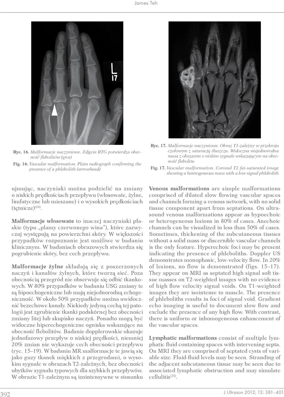 Vascular malformation.