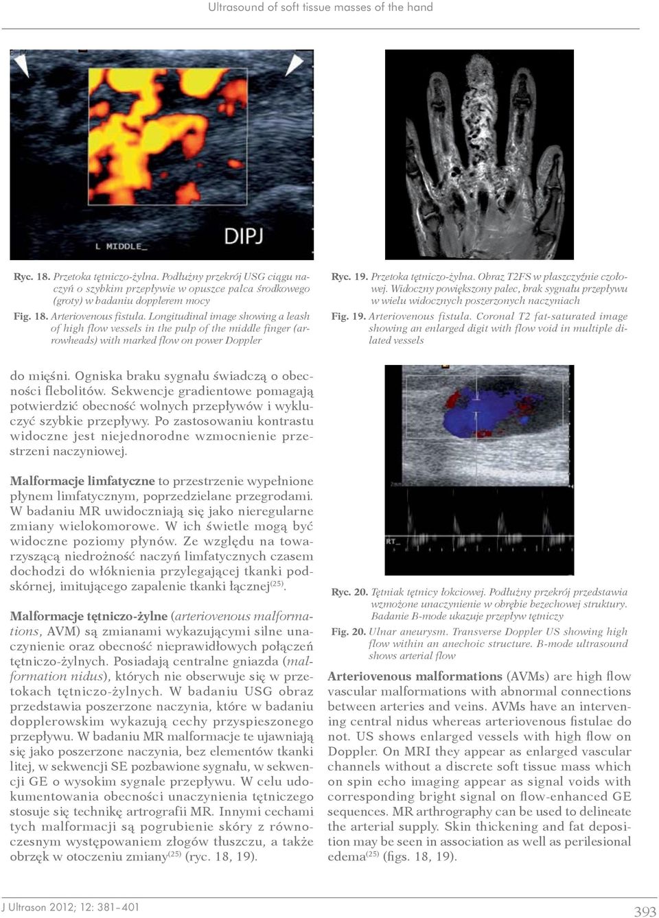 Obraz T2FS w płaszczyźnie czołowej. Widoczny powiększony palec, brak sygnału przepływu w wielu widocznych poszerzonych naczyniach Fig. 19. Arteriovenous fistula.