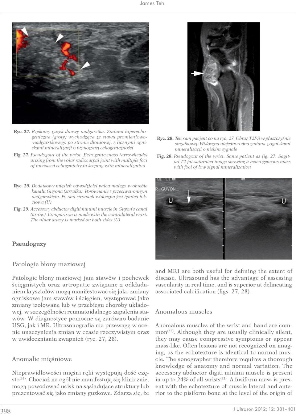 Echogenic mass (arrowheads) arising from the volar radiocarpal joint with multiple foci of increased echogenicity in keeping with mineralization Ryc. 28. Ten sam pacjent co na ryc. 27.
