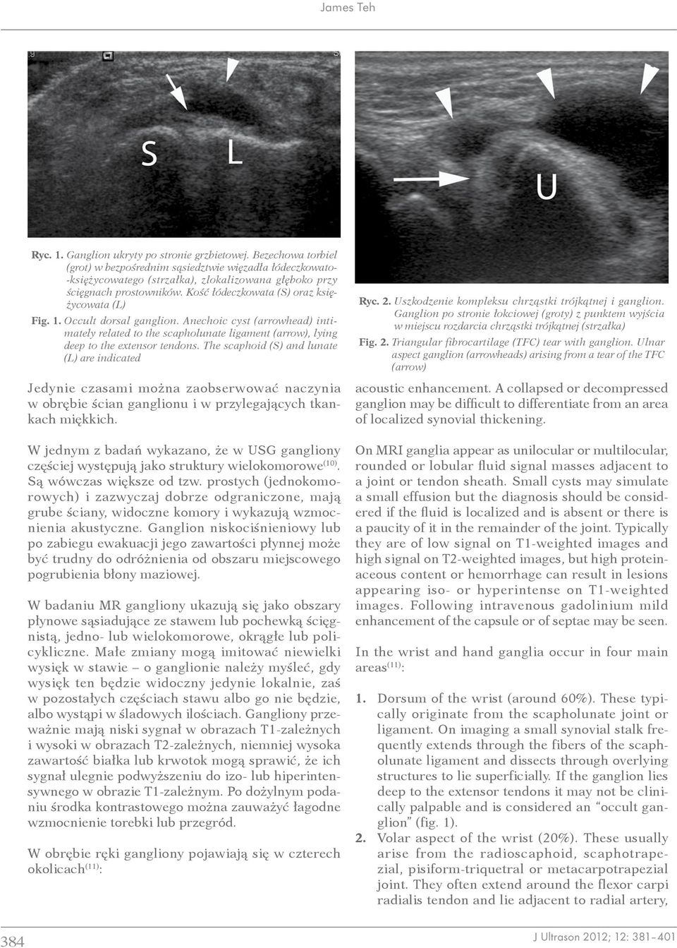 1. Occult dorsal ganglion. Anechoic cyst (arrowhead) intimately related to the scapholunate ligament (arrow), lying deep to the extensor tendons.