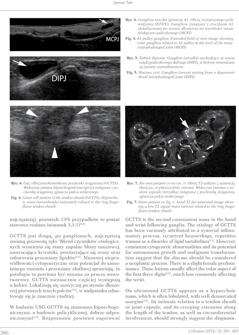 Extended field of view image showing volar ganglion related to A1 pulley at the level of the metacarpophalangeal joint (MCPJ) Ryc. 5. Torbiel śluzowa.