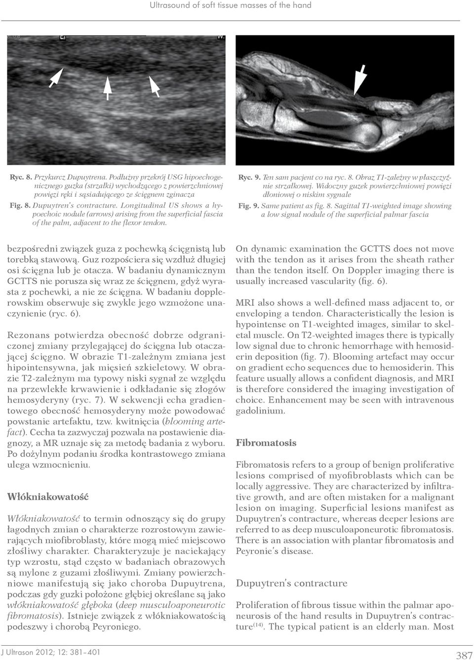 Longitudinal US shows a hypoechoic nodule (arrows) arising from the superficial fascia of the palm, adjacent to the flexor tendon. Ryc. 9. Ten sam pacjent co na ryc. 8.