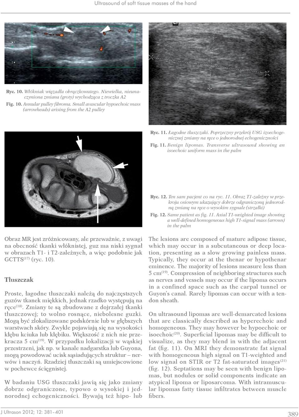 Transverse ultrasound showing an isoechoic uniform mass in the palm Ryc. 12. Ten sam pacjent co na ryc. 11.