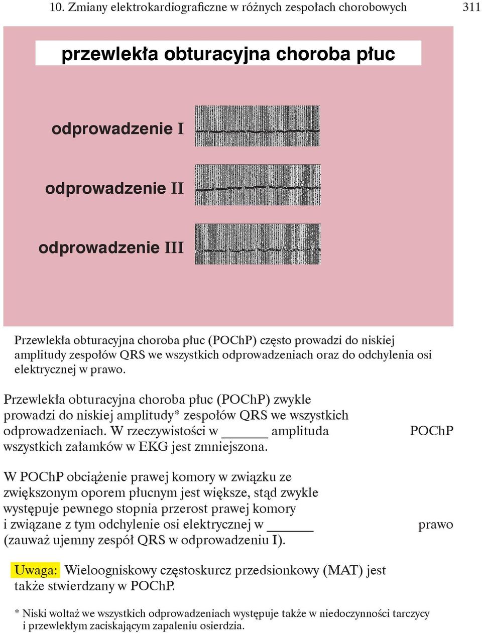 Przewlekła obturacyjna choroba płuc (POChP) zwykle prowadzi do niskiej amplitudy* zespołów QRS we wszystkich odprowadzeniach. W rzeczywistości w amplituda wszystkich załamków w EKG jest zmniejszona.