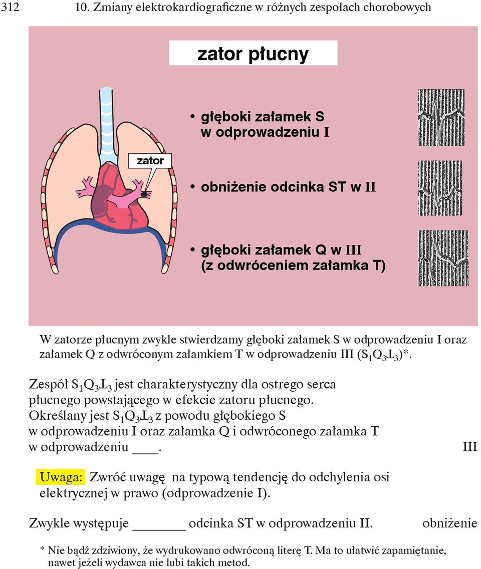 zatorze płucnym zwykle stwierdzamy głęboki załamek S w odprowadzeniu I oraz załamek Q z odwróconym załamkiem T w odprowadzeniu III (S 1 Q 3 3 )*.