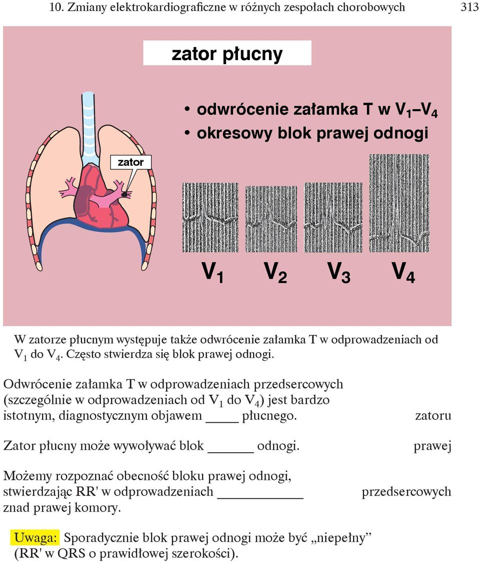 Odwrócenie załamka T w odprowadzeniach przedsercowych (szczególnie w odprowadzeniach od V 1 do V 4 ) jest bardzo istotnym, diagnostycznym objawem płucnego.