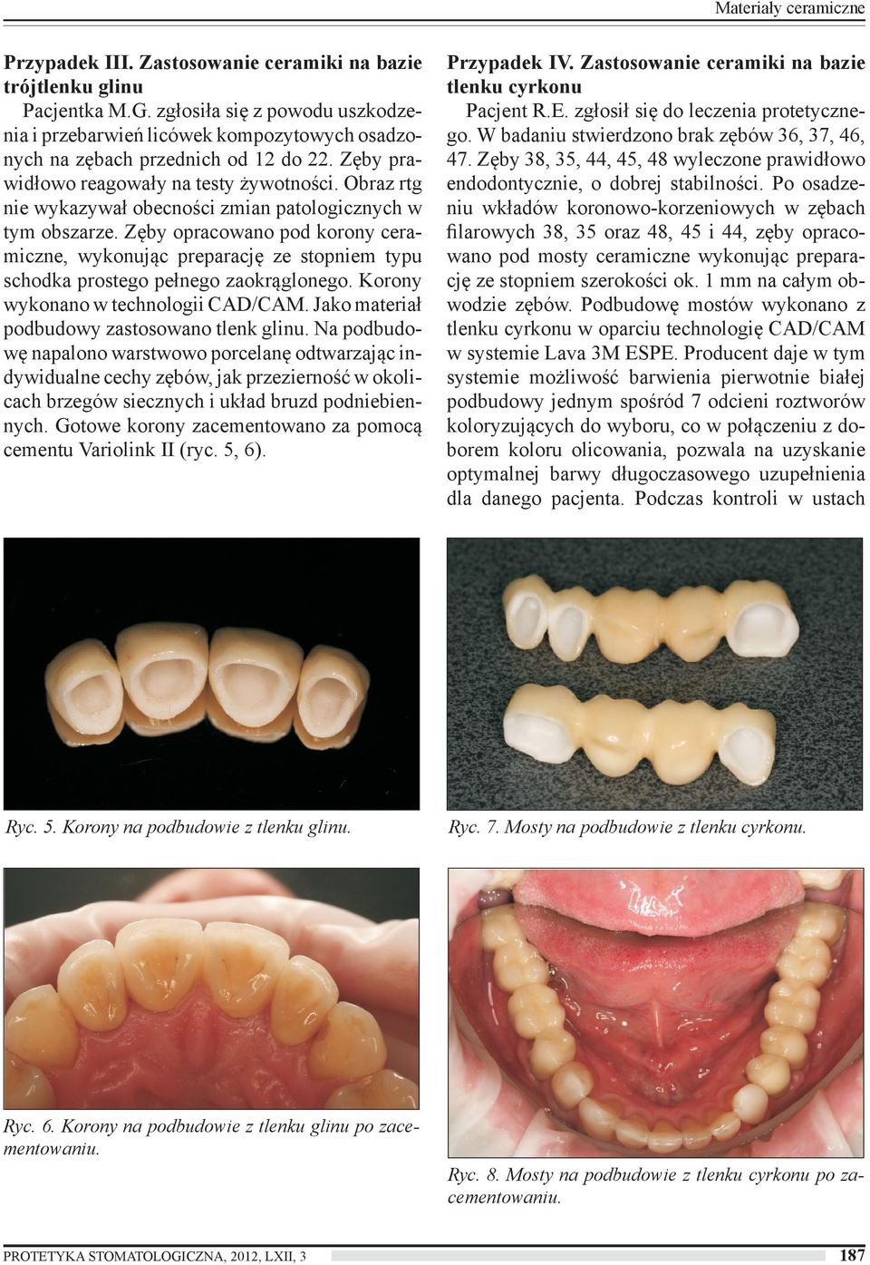Obraz rtg nie wykazywał obecności zmian patologicznych w tym obszarze. Zęby opracowano pod korony ceramiczne, wykonując preparację ze stopniem typu schodka prostego pełnego zaokrąglonego.