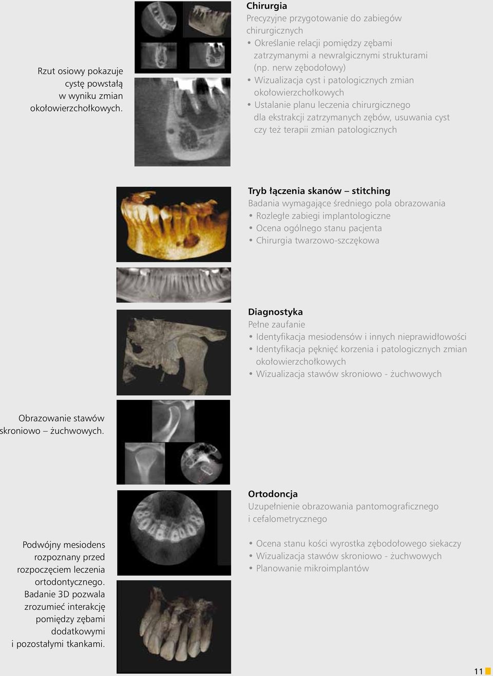 nerw zębodołowy) Wizualizacja cyst i patologicznych zmian okołowierzchołkowych Ustalanie planu leczenia chirurgicznego dla ekstrakcji zatrzymanych zębów, usuwania cyst czy też terapii zmian