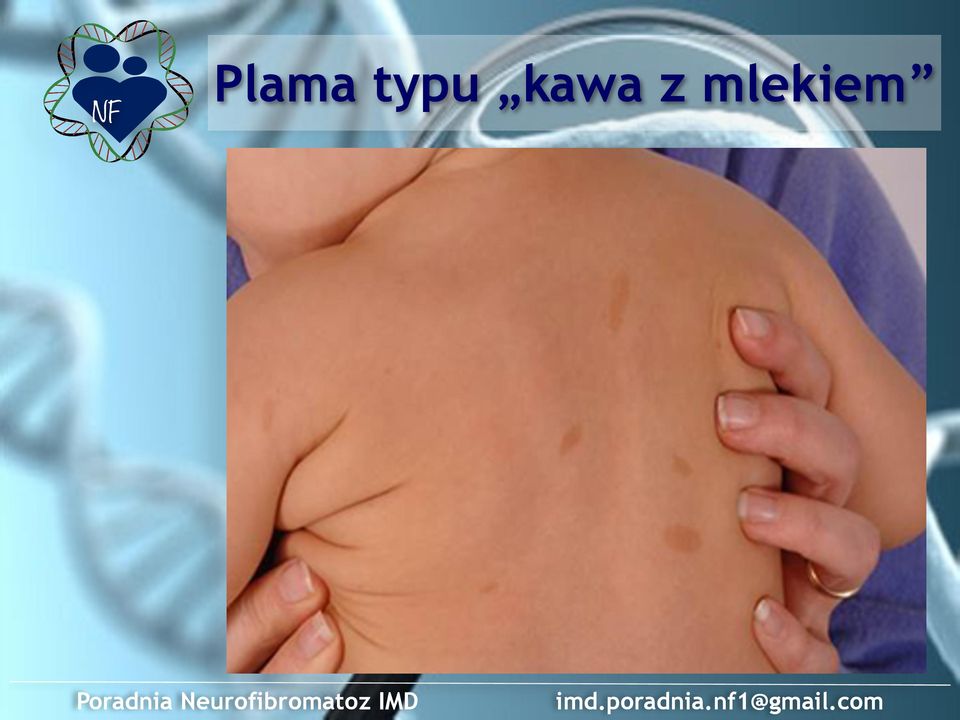 Neurofibromatoz IMD