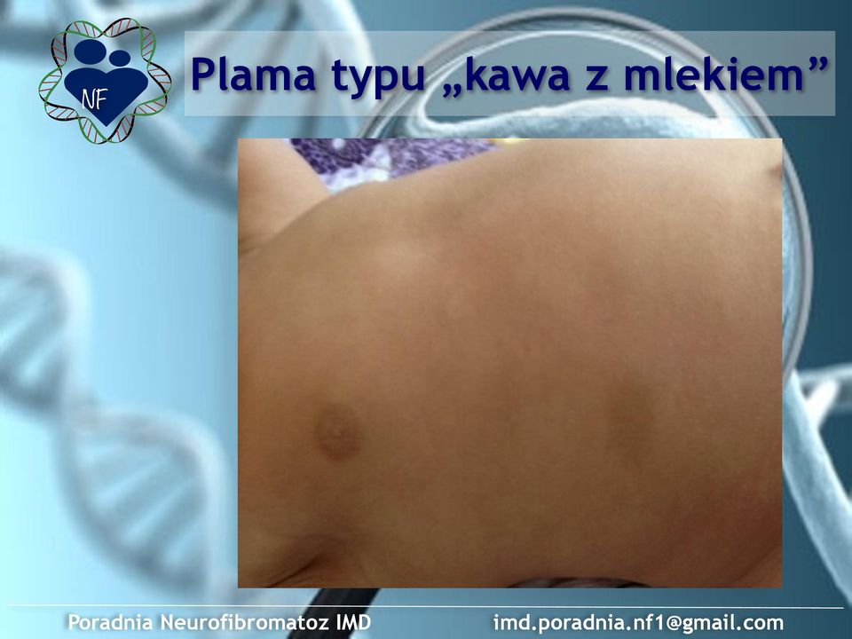 Neurofibromatoz IMD