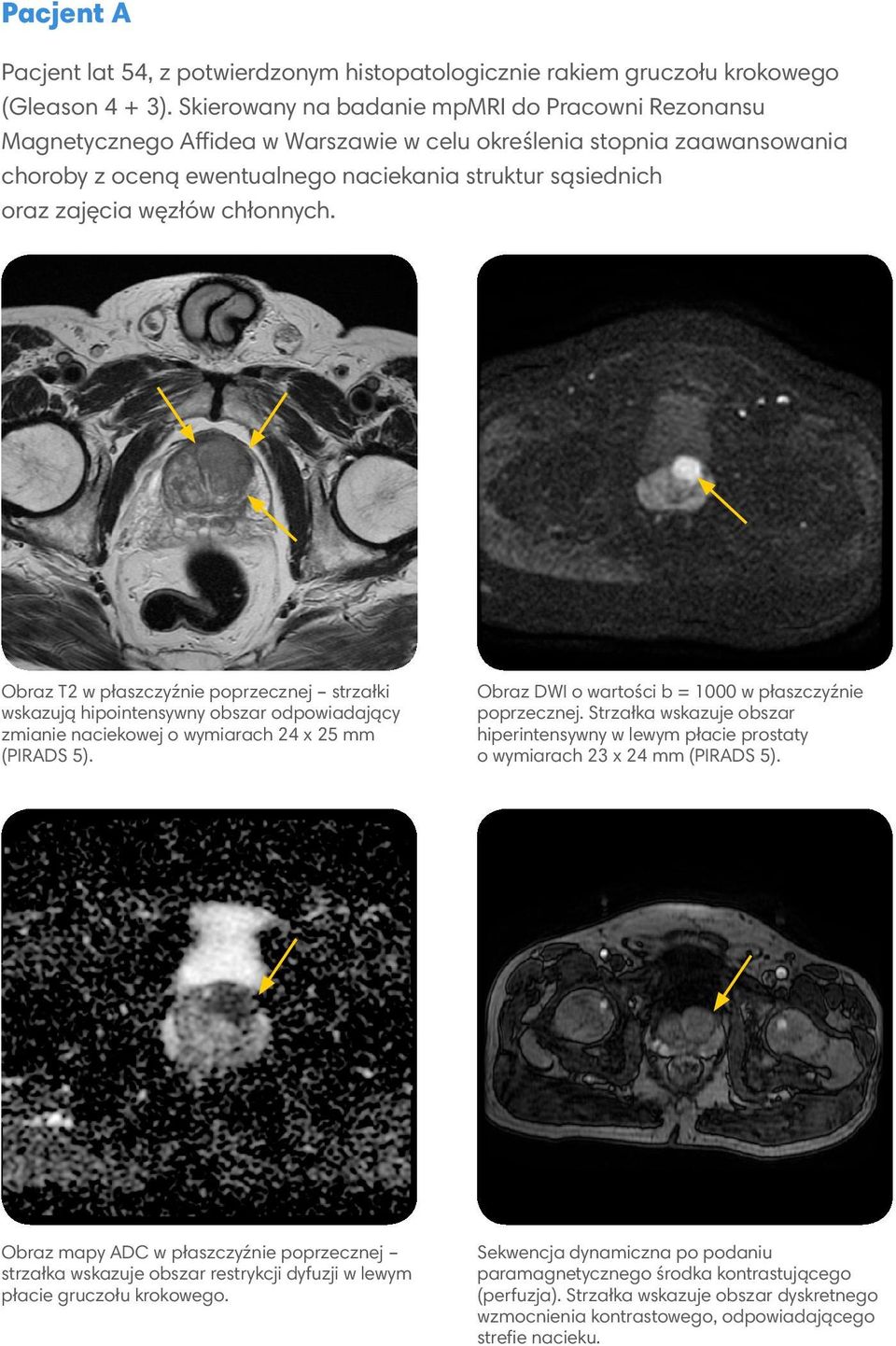 węzłów chłonnych. Obraz T2 w płaszczyźnie poprzecznej strzałki wskazują hipointensywny obszar odpowiadający zmianie naciekowej o wymiarach 24 x 25 mm (PIRADS 5).