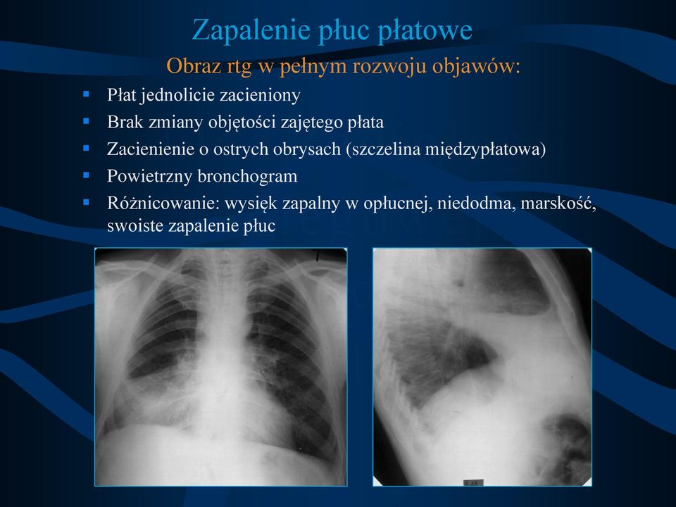 o ostrych obrysach (szczelina międzypłatowa) Powietrzny bronchogram