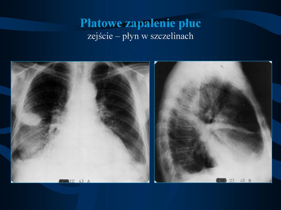 płuc zejście