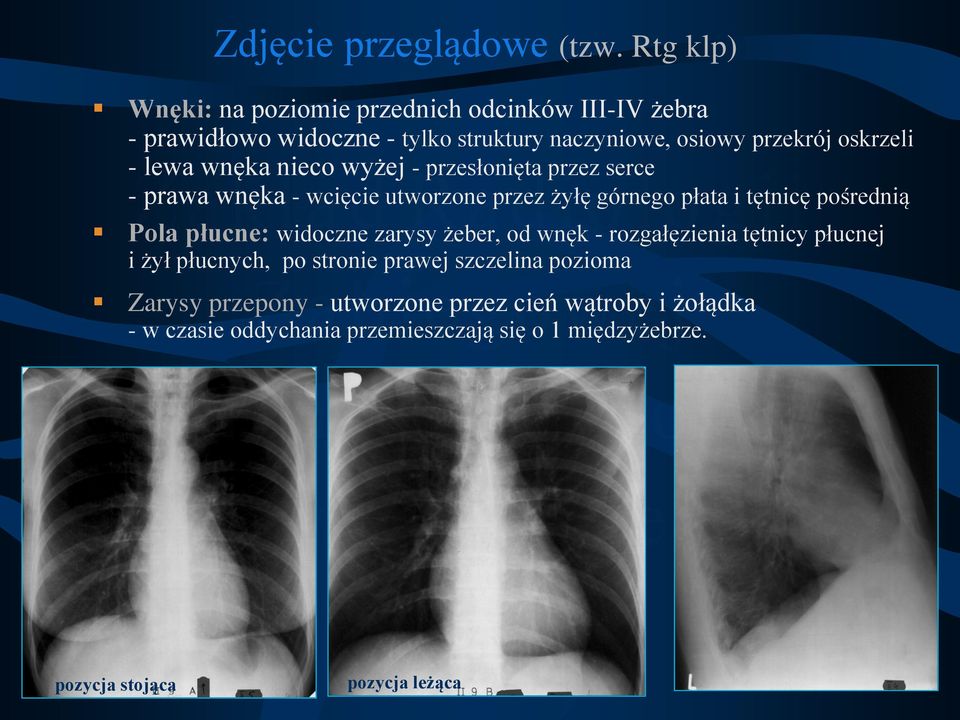 lewa wnęka nieco wyżej - przesłonięta przez serce - prawa wnęka - wcięcie utworzone przez żyłę górnego płata i tętnicę pośrednią Pola płucne: